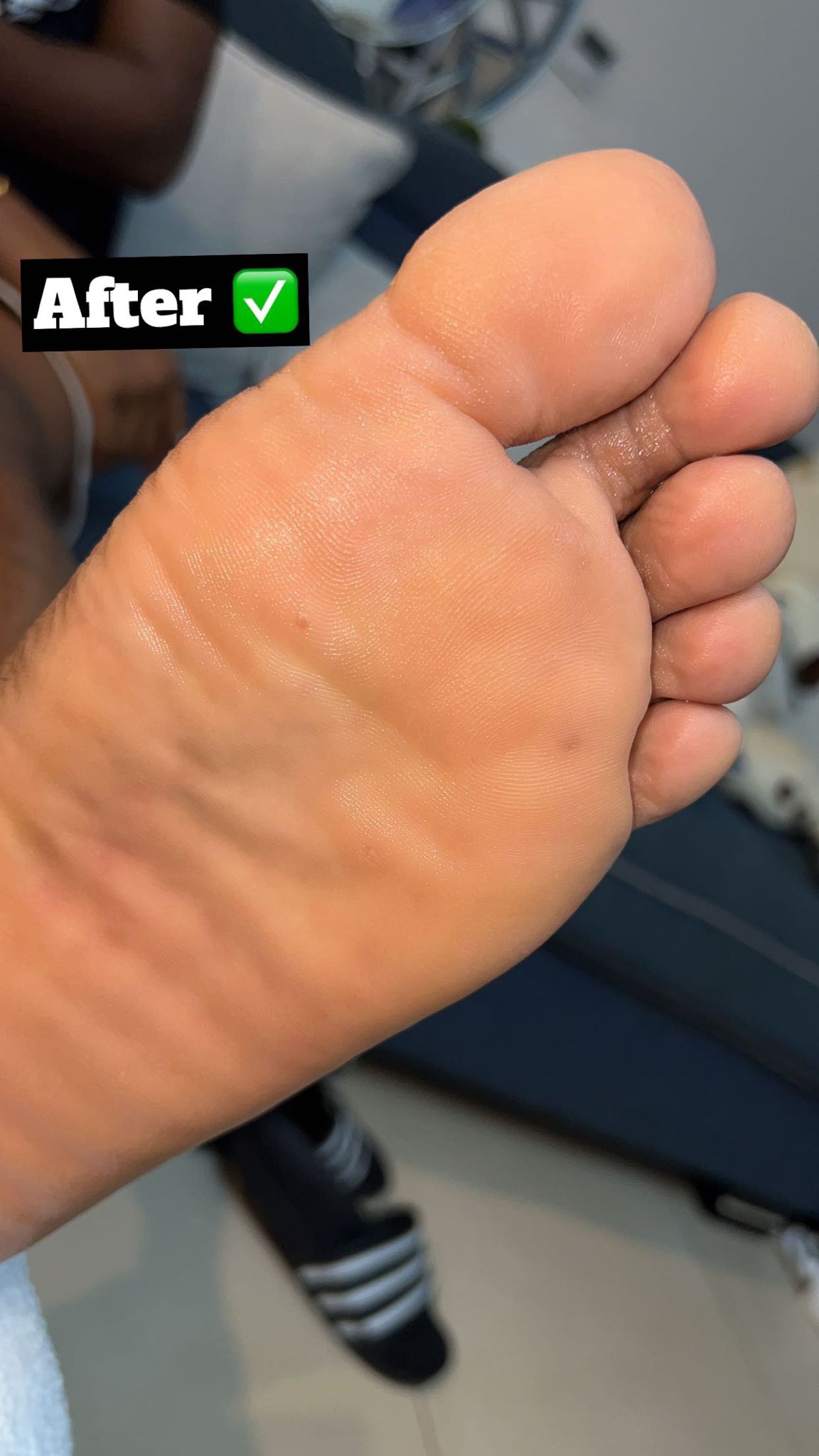Foot care result after treatment